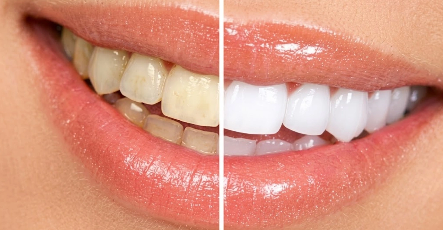 Teeth Whitening Treatments Inblog